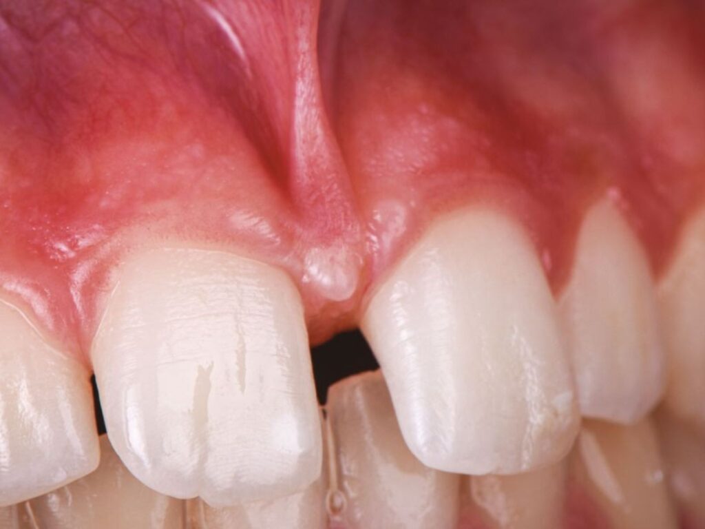 Frenectomie Cabinet Dentaire de la Lone - dentiste - Boulbon